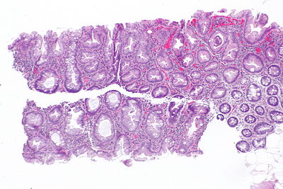 Sessile serrated adenoma ~ low mag.jpg