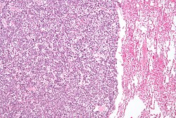 Lung carcinoid - low mag.jpg