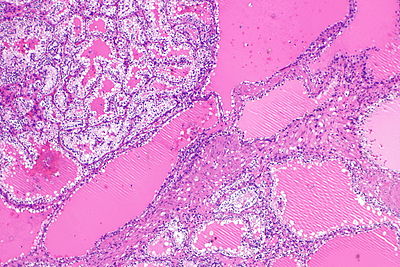 Clear cell tubulopapillary RCC with smooth muscle stroma -- low mag.jpg