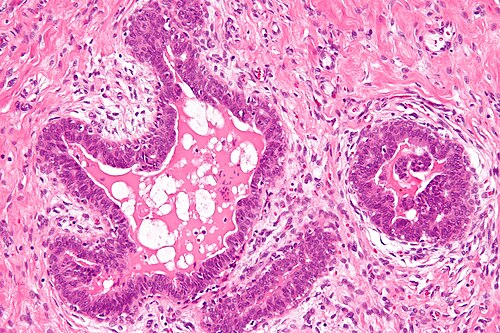 Gynecomastoid hyperplasia - high mag.jpg
