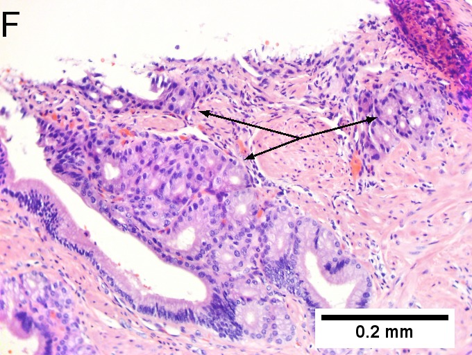 Invasive carcinoma of duodenal ampulla.
