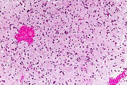 Anaplastic astrocytoma - high mag.jpg