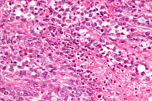 Small cell carcinoma of the ovary hypercalcemic type - very high mag.jpg