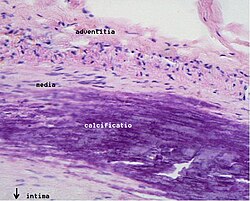 Medial calcific sclerosis - Libre Pathology