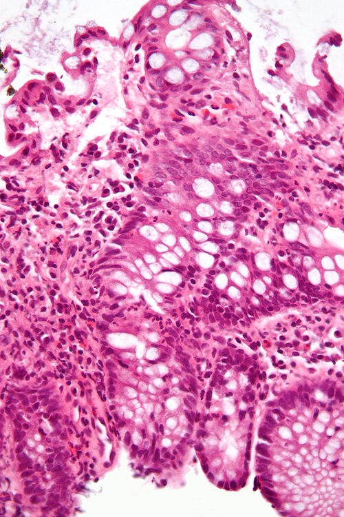 File:Cryptitis high mag.jpg