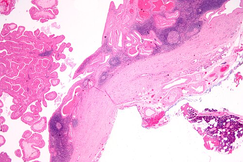 Papillary cystadenoma lymphomatosum1.jpg