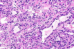 TFEB-rearranged renal cell carcinoma - Libre Pathology