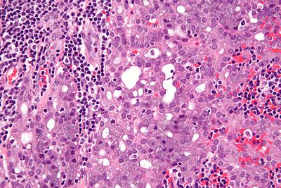 Acinic cell carcinoma - very high mag.jpg