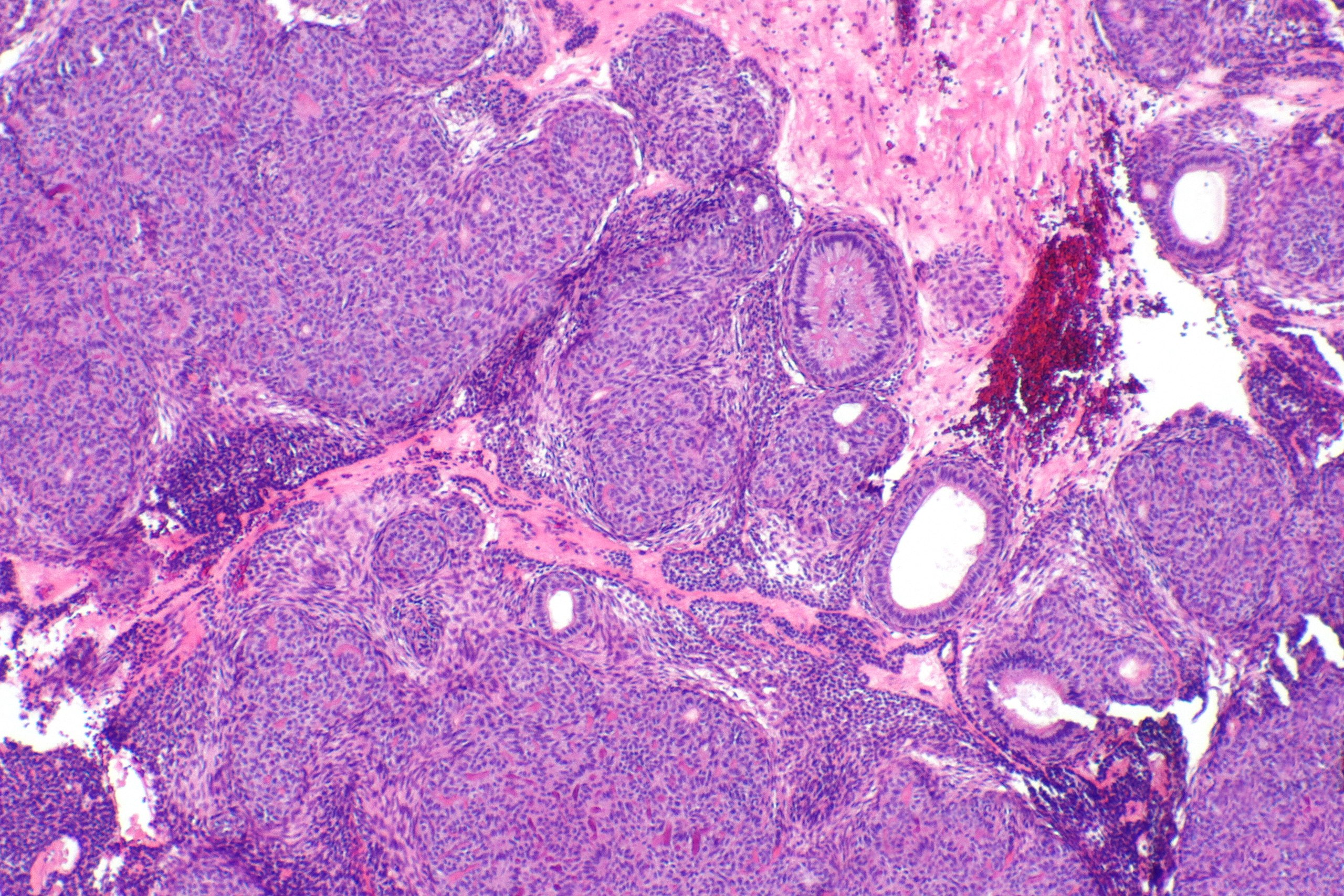 Adenomatoid tumor pathology outlines