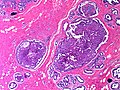 Squamous papilloma libre pathology Hpv virus and bladder cancer