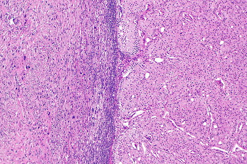 Chromophobe renal cell carcinoma with sarcomatoid differentiation -- low mag.jpg