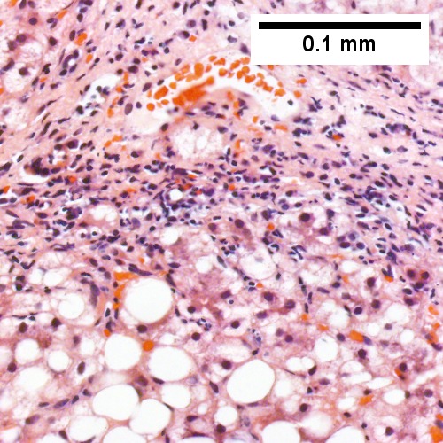 Hematoxylin and eosin shows piecemeal necrosis as inflammatory cells surrounding hepatocytes (Row 3 Left 400X).