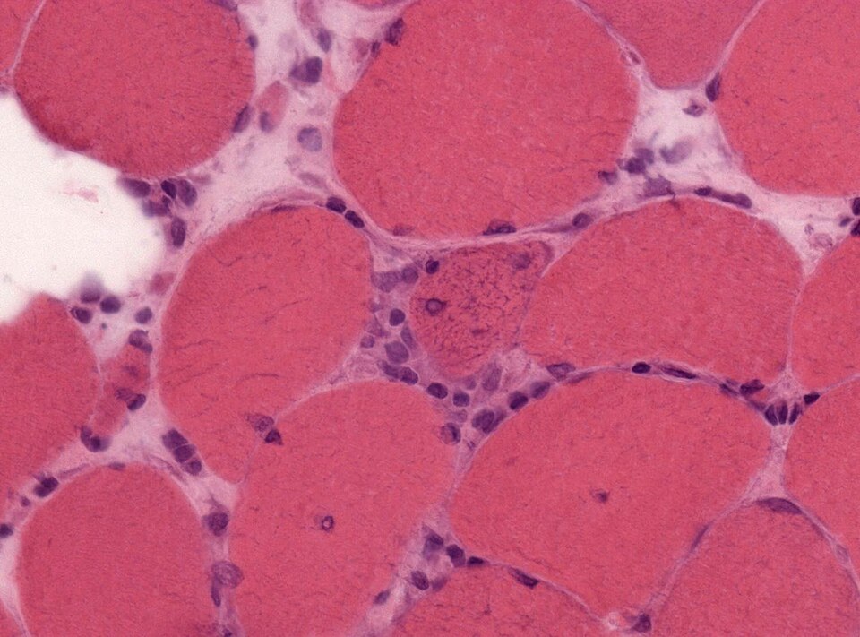 File:Neuropathology case XII 02.jpg