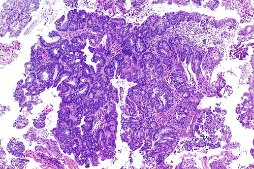 Adenocarcinoma of the urinary bladder -- low mag.jpg