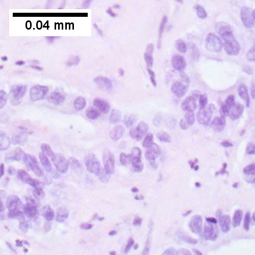Cholangiocarcinoma, intrahepatic, large duct type.