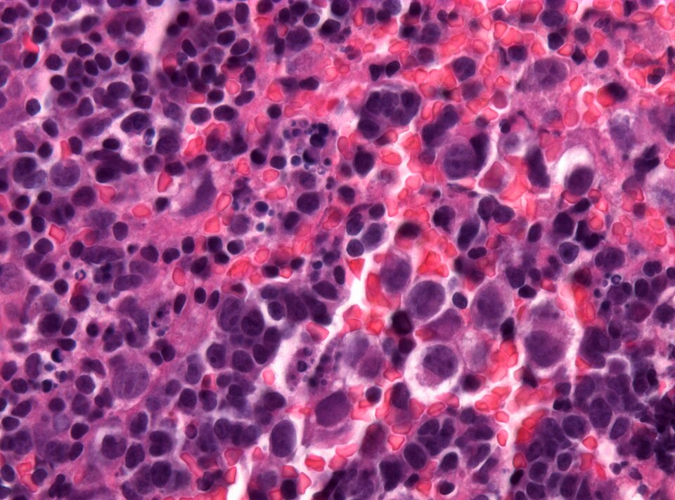 File:Neuropathology case VIII 03.jpg