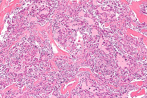 Medullary thyroid carcinoma - 2 - intermed mag.jpg