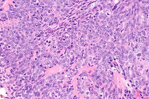nasopharyngeal carcinoma histology