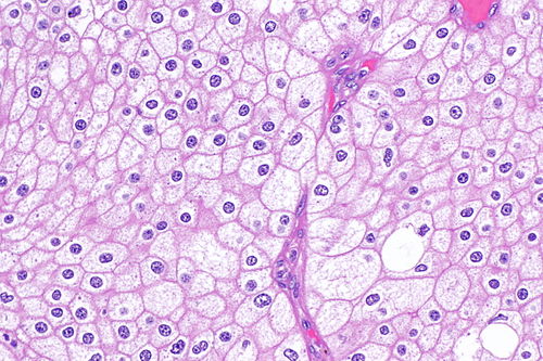 Chromophobe renal cell carcinoma -- high mag.jpg