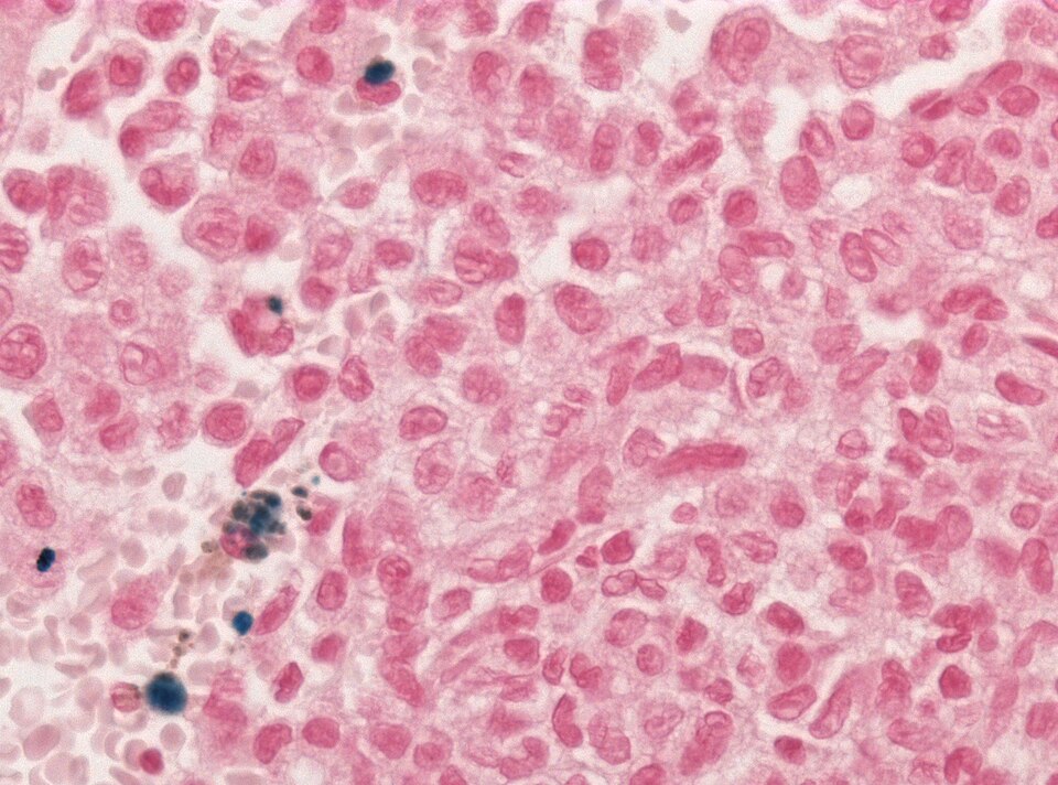 File:Neuropathology case VII 04.jpg