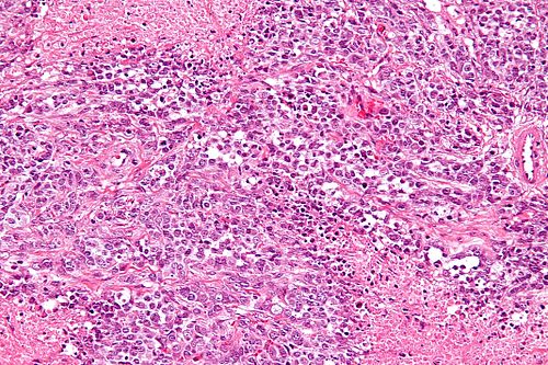 Small cell carcinoma of the ovary hypercalcemic type - high mag.jpg