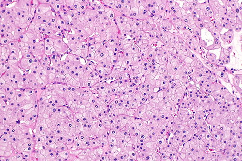Eosinophilic variant of chromophobe renal cell carcinoma -- intermed mag.jpg
