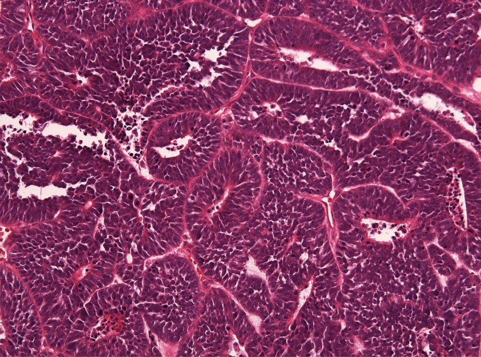 File:Ependymoblastoma ETMRjpg.jpg