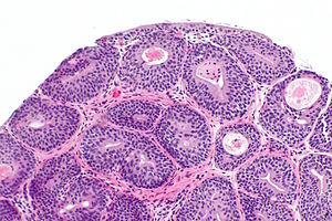 bladder papilloma libre pathology)