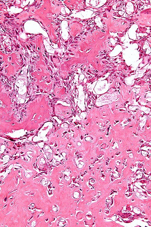 File:Osteoblastoma - high mag.jpg