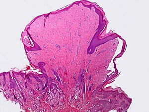 irritated fibroepithelial papilloma