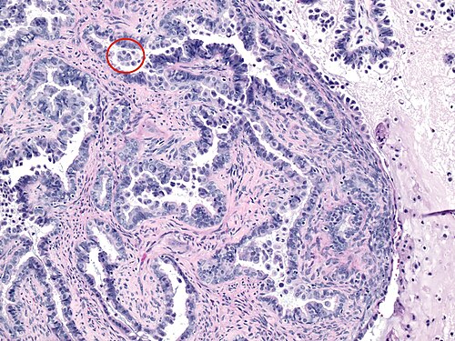 Intermediate magnification of a borderline serous tumor showing eosiniophilic cells.jpg