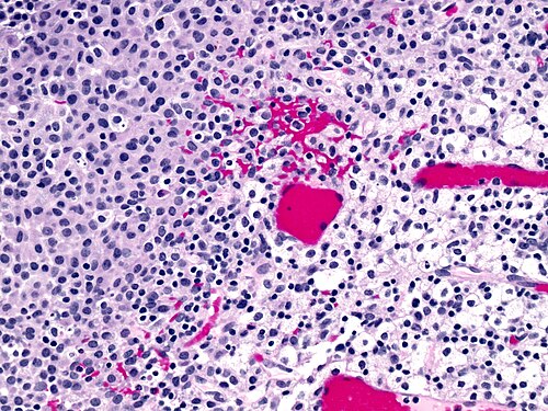 Nodular histocytic hyperplasia high mag.jpg