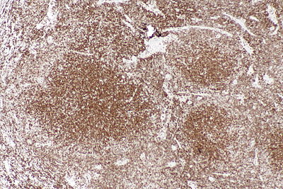 Follicluar lymphoma - bcl2 -- low mag.jpg