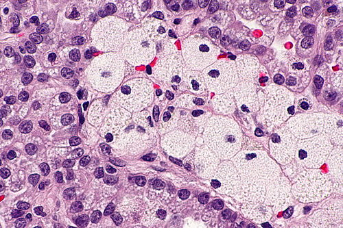 Papillary renal cell carcinoma - 2 -- very high mag.jpg