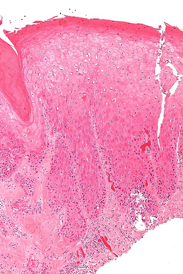 Differentiated vulvar intraepithelial neoplasia - Libre Pathology