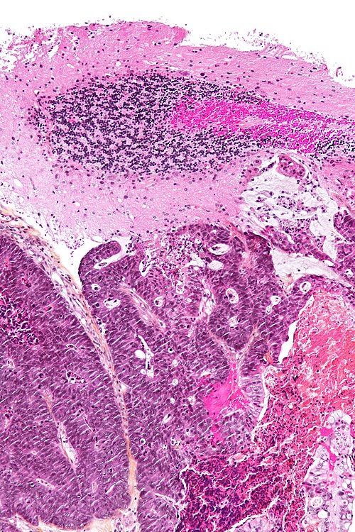 Metastatic adenocarcinoma - cerebellum - intermed mag.jpg