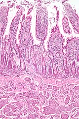 neuroendocrine intestine duodenum cancer tumour intellicig papilloma aceto mele wc nephron librepathology neoplasms