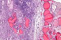 Struma ovarii - intermed mag.jpg