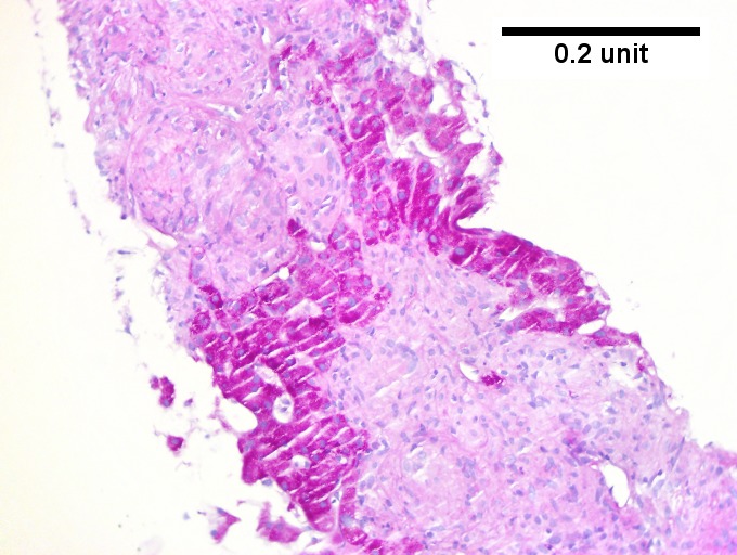 Hepatic sarcoidosis in a patient with previously known sarcoidosis.