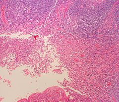 Traumatic ulcerative granuloma with stromal eosinophilia 