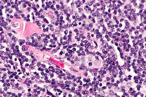Follicular lymphoma -- very high mag.jpg