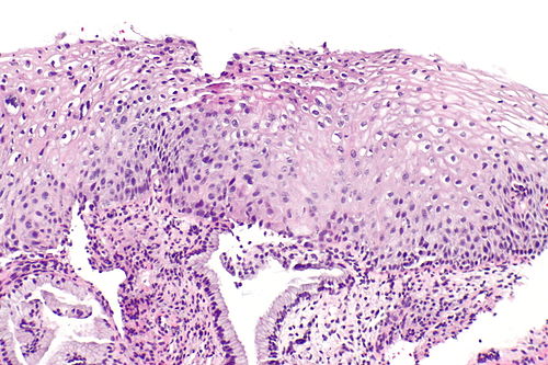 Low-grade squamous intraepithelial lesion -- intermed mag.jpg