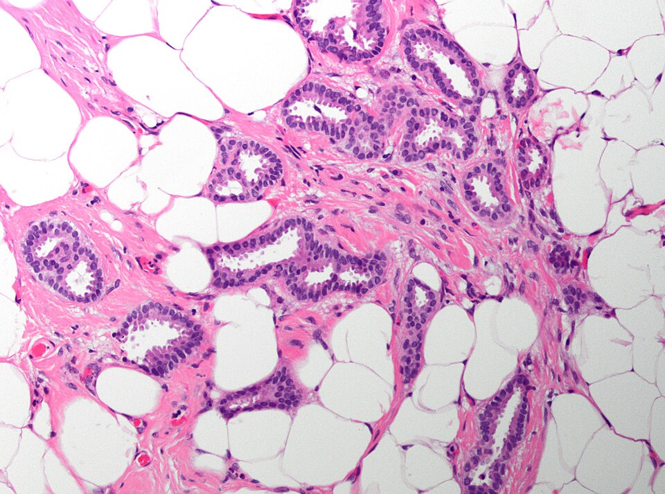 File:18S08891 tubular carcinoma x20a.jpg