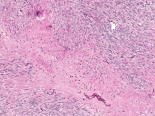 Leiomyoma with changes secondary to tranexamic acid treatment high magnification.jpg