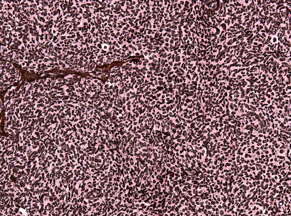 File:Neuropathology case VII 05.jpg