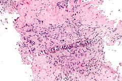 Placental site nodule - Libre Pathology