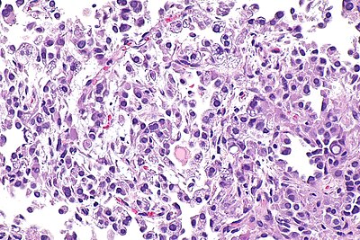 Pneumocytoma -- high mag.jpg