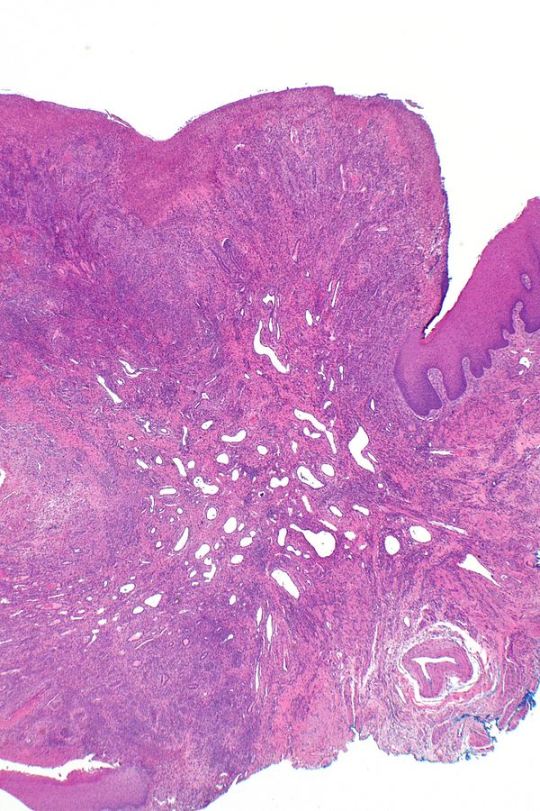 Granuloma - Libre Pathology