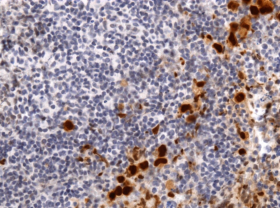 File:Neuropathology case VIII 05.jpg