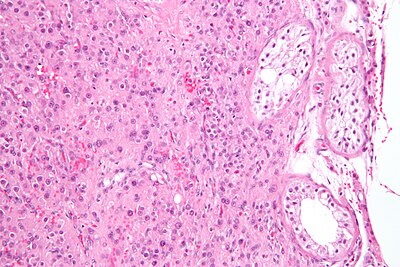 Leydig cell tumour2.jpg